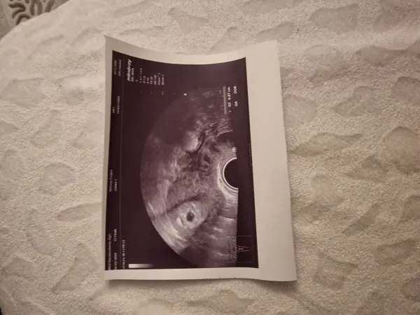 Ein Ultraschallbild liegt flach auf einem strukturierten, hellen Stoffhintergrund. Text auf dem Bild enthält medizinische Messdaten.