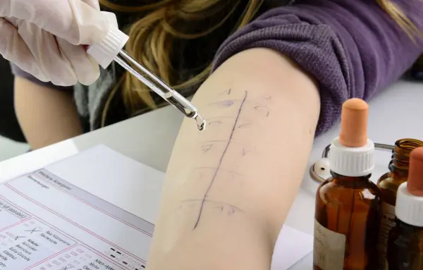 Ein Arm mit markierten Bereichen erhält mit einer Pipette Flüssigkeit für einen Allergietest. Im Hintergrund stehen Fläschchen.