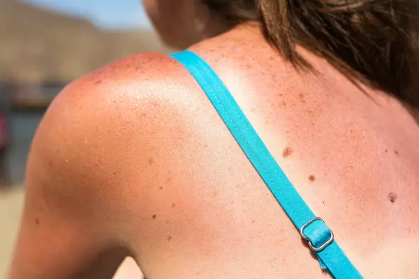Eine von Sonnenbrand betroffene Schulter ist sichtbar, während die Person mit blauer Trägerbluse am Strand sitzt.