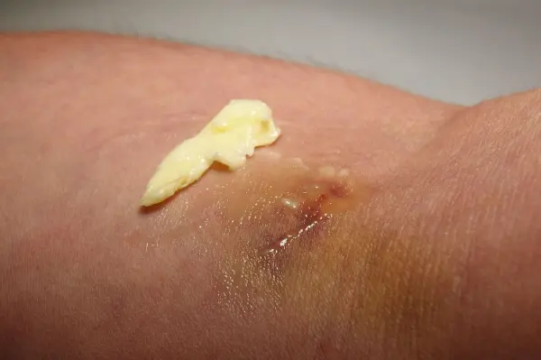 Auf einer Hautstelle liegt Butter, die einen blauen Fleck zu behandeln versucht, während der Arm in einem häuslichen Umfeld ist.