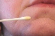 Propolis gegen Pickel im Gesicht