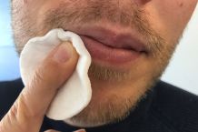 Herpes bekämpfen - extrem aber wirksam