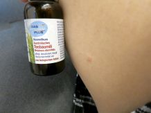 Teebaumöl bei Insektenstichen