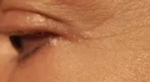 Augenfältchen - Krähenfüße