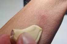 Knoblauch gegen Mückenstiche