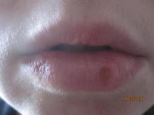 Isopropyl-Alkohol gegen Lippenherpes