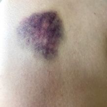 Brot und Zucker gegen blaue Flecken und Beulen