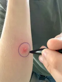 Kugelschreiberkreise bei Stichen