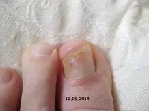 Nagelpilz ausheilen - sehr effektiv