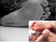 Füße ohne Hornhaut