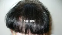 Lichtes Haar/kahle Stellen verdichten und unsichtbar machen