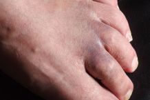 Gefrorenes Küchenhandtuch gegen blaue Flecken