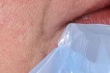 Kälte gegen Herpes