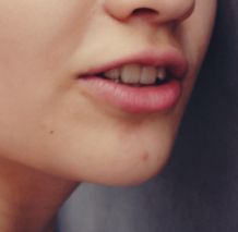 Herpes: Was man dagegen tun kann