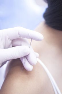 Schmerzen behandeln mit Dry Needling