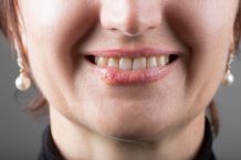 Herpes schnell bekämpfen