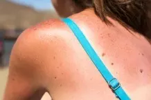 Sonnenbrand behandeln: 3 Tipps zum Schmerzen lindern
