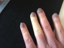 Raynaud-Syndrom: Weiße, gefühllose und eiskalte Finger, was tun?