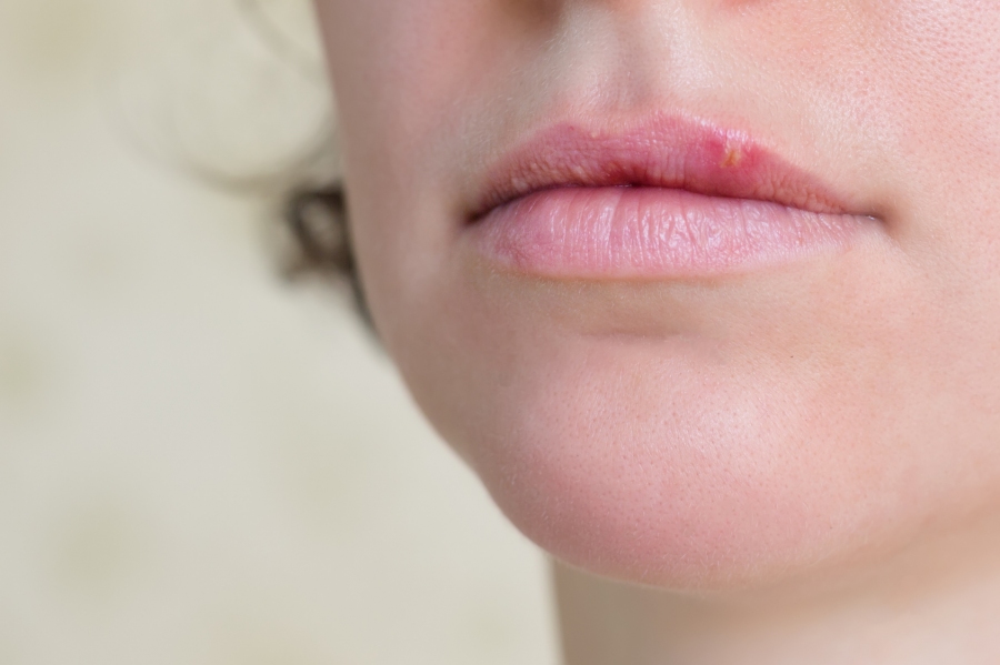 Honig unterstützt die Heilung von Lippenherpes