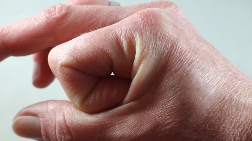 Lupenersatz: Man winkelt einen Zeigefinger stark an, und zwar so, dass das erste Fingergelenk auf der Haut zwischen Daumen und Zeigefinger liegt. 