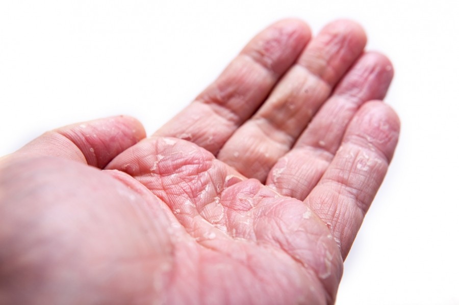 Schuppenflechte an den Händen mit Salicylsalbe 5% bekämpfen.