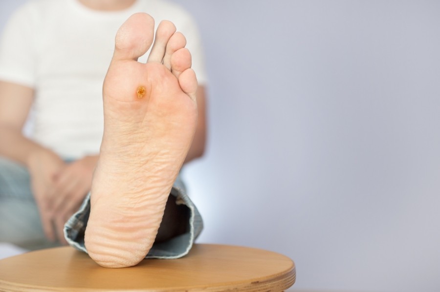 Fuß entfernen unterm dornwarze Dornwarzen: Ursachen