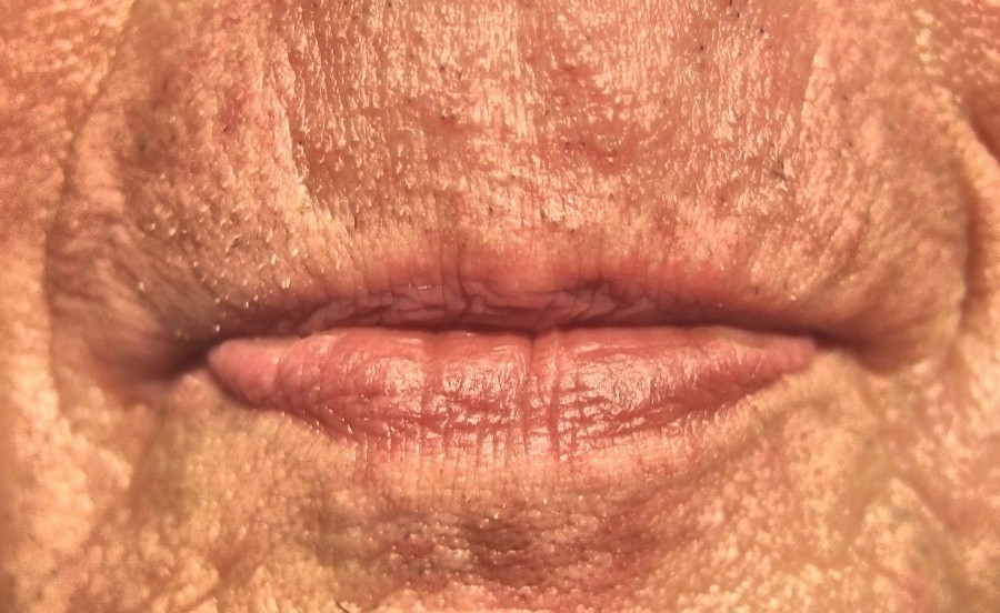 Gegen raue und schmerzende Lippen: Ein bisschen Wollwachs (Adeps lanae) aus der Apotheke und damit die Lippen mehrmals täglich leicht eincremen.