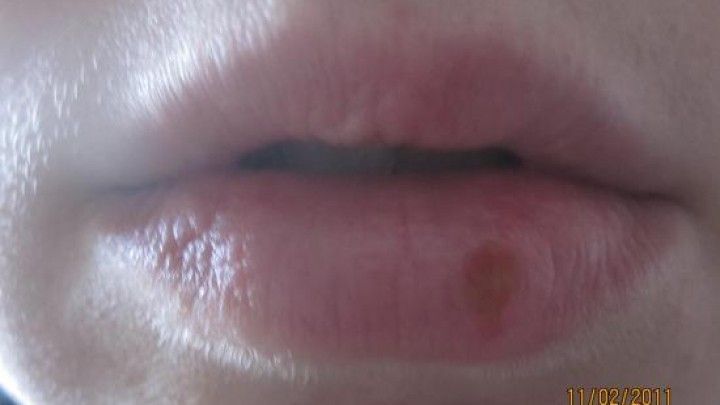 Isopropyl Alkohol Gegen Lippenherpes Frag Mutti