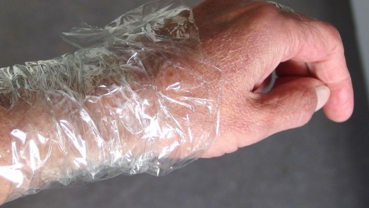 Mit einem "Verband" aus Frischhaltefolie bleibt die Salbe an Ort und Stelle.