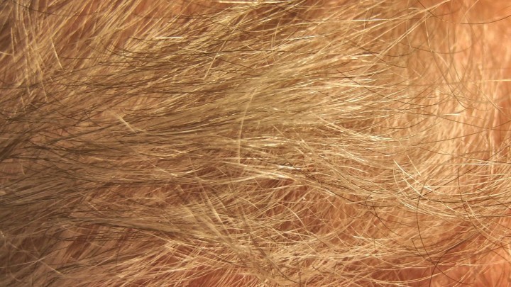 Tipp Gegen Haarausfall Frag Mutti