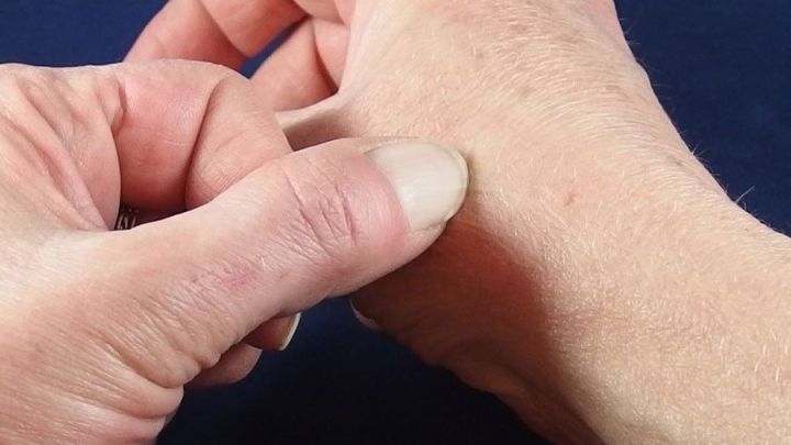 Wenn ein Mückenstich sehr stark juckt, einfach mit dem Fingernagel ein Kreuz reinpiksen.