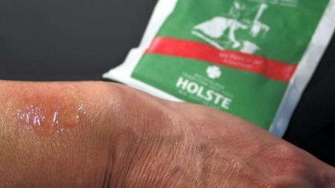 Etwas Natron (auch Speisesoda, Kaisernatron genannt) mit Wasser lindert Juckreiz nach einem Mückenstich.