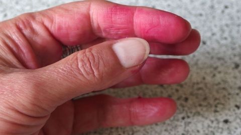 Vitamin C Pulver bei verfärbten Fingern durch Rote Beete: Hilft auch gut bei Selbstbräunungscreme oder anderen natürlichen Färbern.