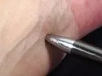 Mückenstich mit Kugelschreiber "bearbeiten"