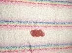 Blutentfernung aus Textilien