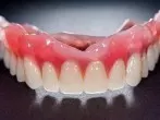 Zahnersatz günstiger reinigen
