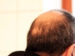 Tipp für mehr Haare - Gegen <strong>Haarausfall</strong>