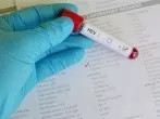 Hepatitis E durch Fleischprodukte: Wie groß ist das Risiko?