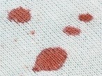 Eingetrocknete Blutflecken problemlos entfernen