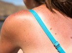 Sonnenbrand behandeln: 3 Tipps zum <strong>Schmerzen</strong> lindern