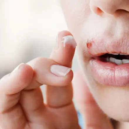 Herpes - die Kombi machts!