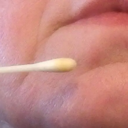 Propolis gegen Pickel im Gesicht