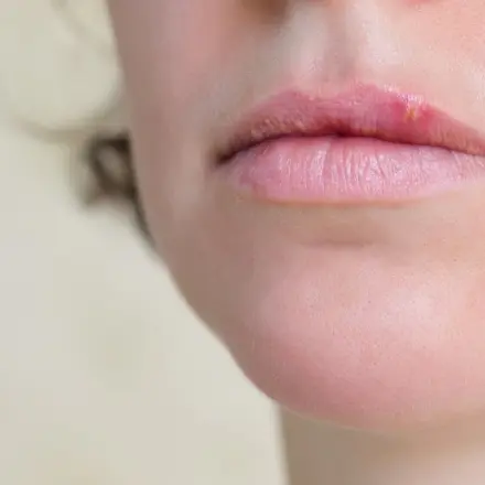 Herpestherapie mit Honig