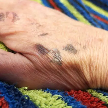 Farbe nach Haartönung auf der Haut mit Nagellackentferner entfernen