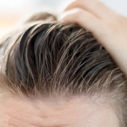 Schnell fettendes Haar