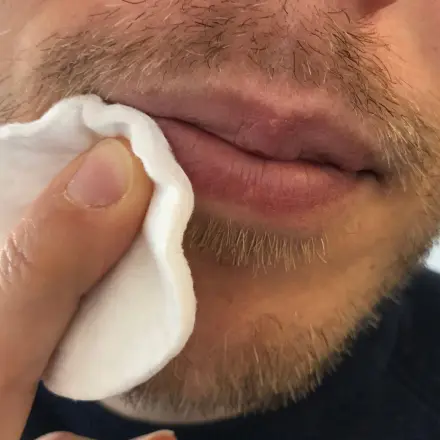 Herpes bekämpfen - extrem aber wirksam