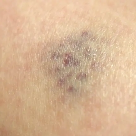 Blaue Flecken bei Kindern