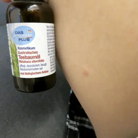 Teebaumöl bei Insektenstichen