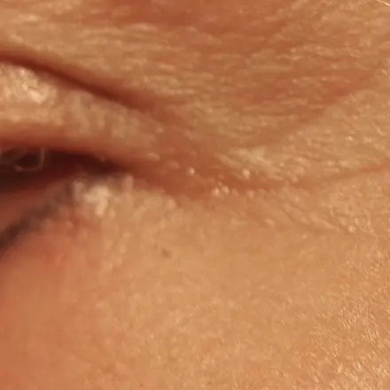 Augenfältchen - Krähenfüße