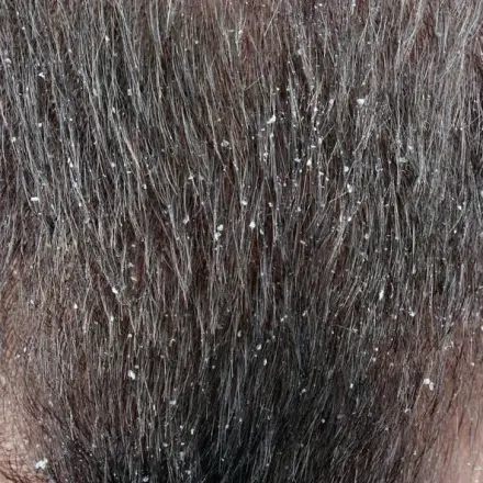 Salzwasser gegen Schuppenflechte